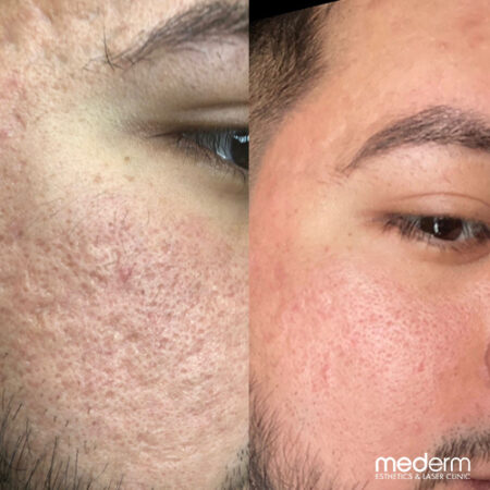 Acne scars
