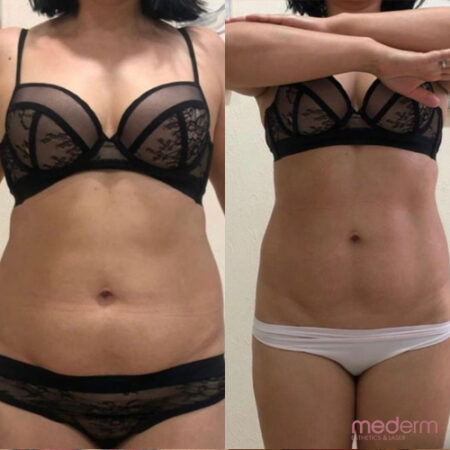 Body Contouring