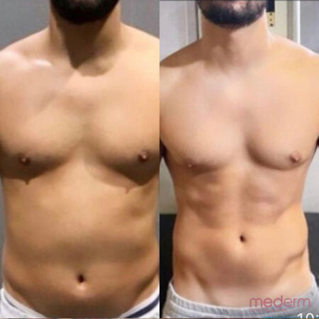 Body Contouring
