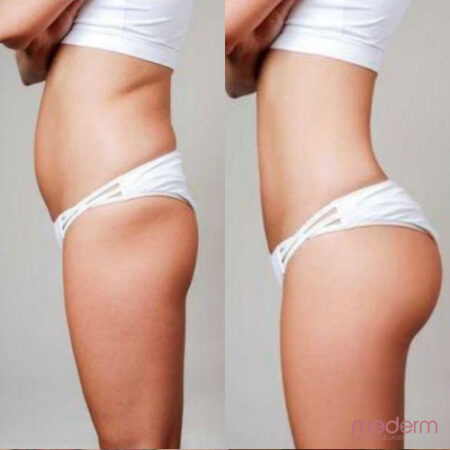 Body Contouring