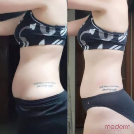 Body Contouring