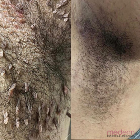Electrocautery