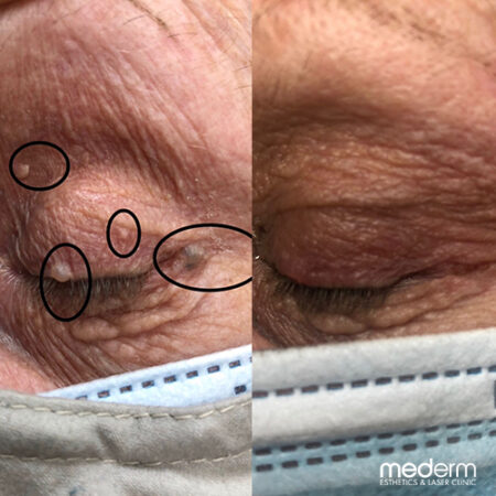 Electrocautery