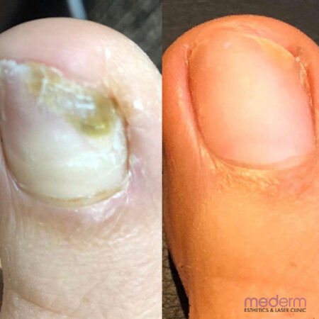 Nail Fungus