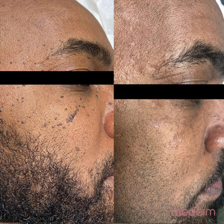 Electrocautery