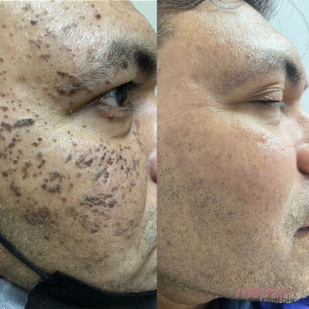 Electrocautery
