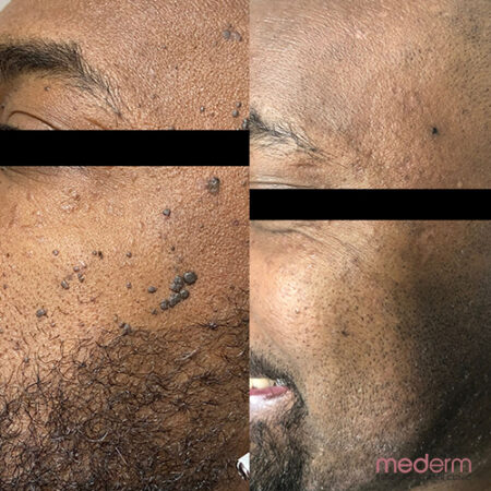 Electrocautery