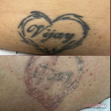 Tattoo Removal