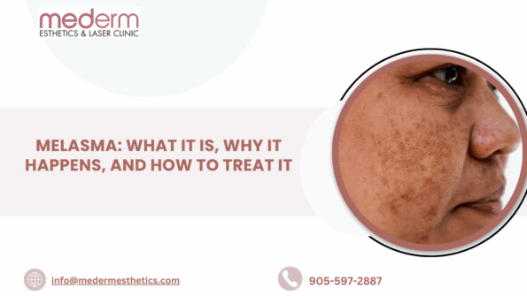 Melasma Treatment in Vaughan
