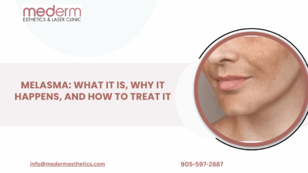 Melasma Treatment in Vaughan