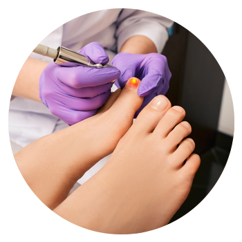 Nail Fungus Treatment in Vaughan