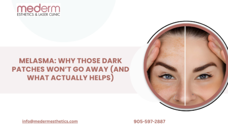 Melasma Treatment in GTA