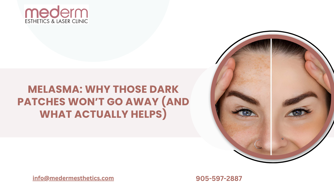 Melasma Treatment in GTA