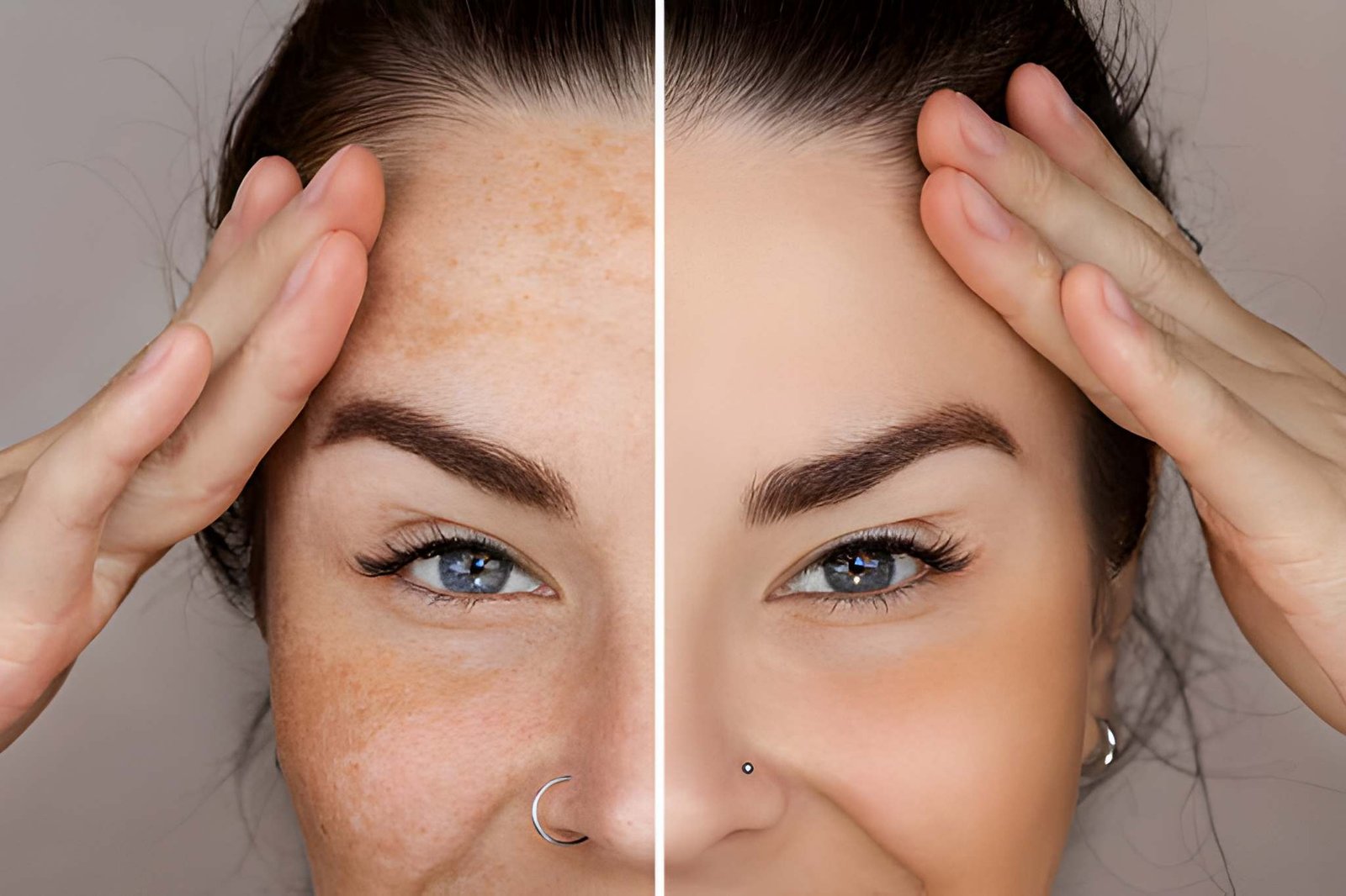 Melasma and Hyperpigmentation Treatment in Vaughan