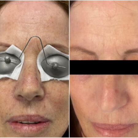 Photo Facial​