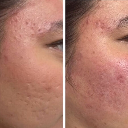Scar Treatment