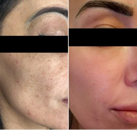 Melasma & Hyperpigmentation