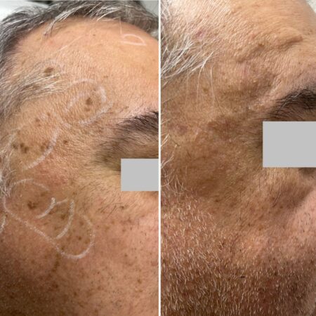 Electrocautery