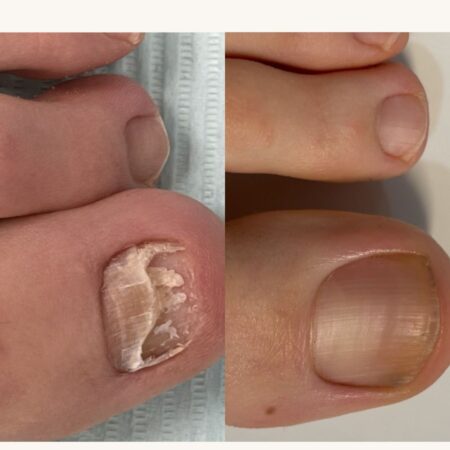 Nail Fungus