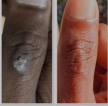 Warts